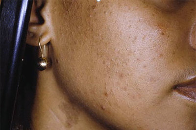 acne in skin of color